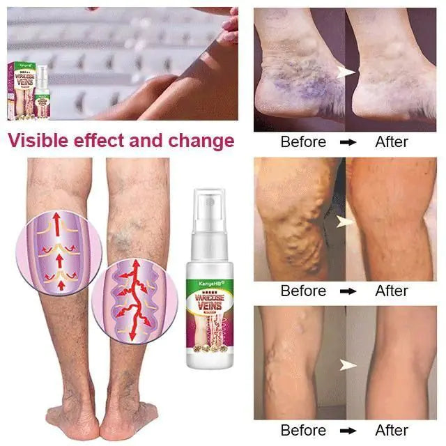 Varicose Veins Treatment Spray